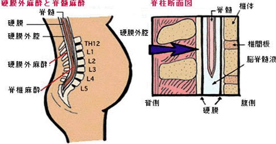 无痛分娩真的无痛吗？揭秘分娩镇痛的真相