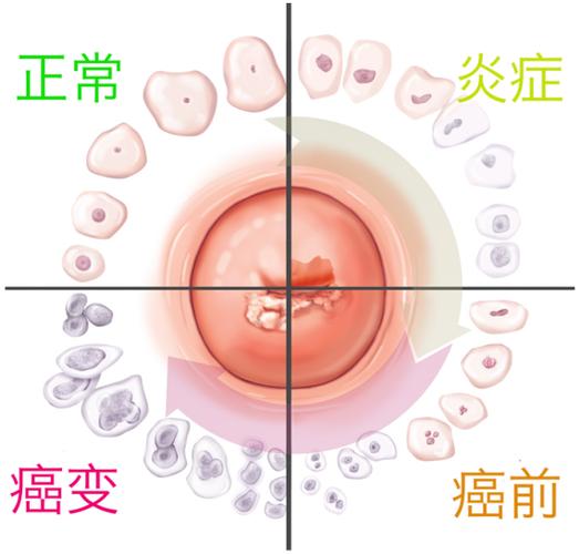 宫颈病变二级怎么治疗最好？专家探讨最新疗法