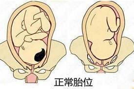 深度新闻解读臀位纠正胎位的方法探究